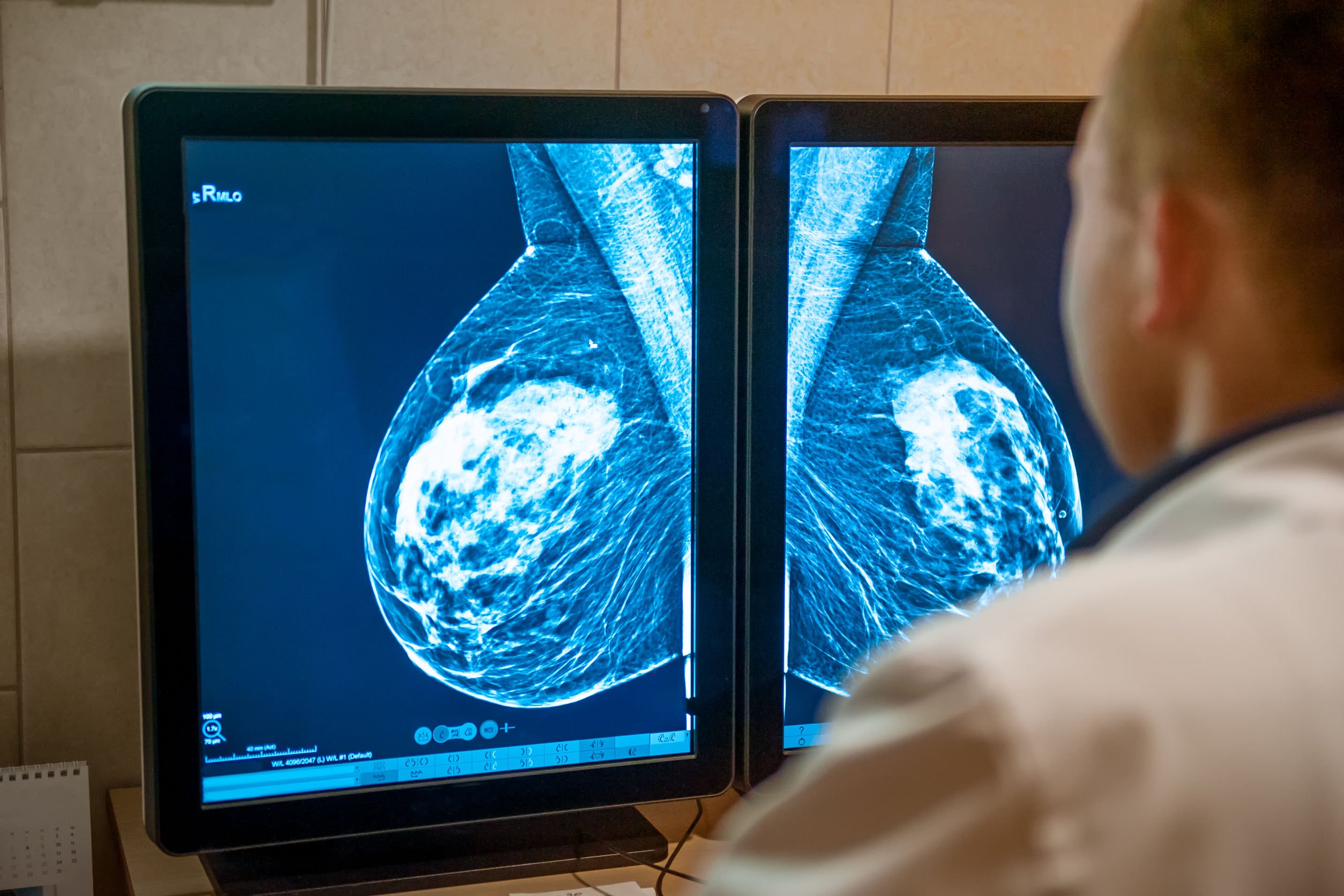 Médico olhando imagem de duas mamografias